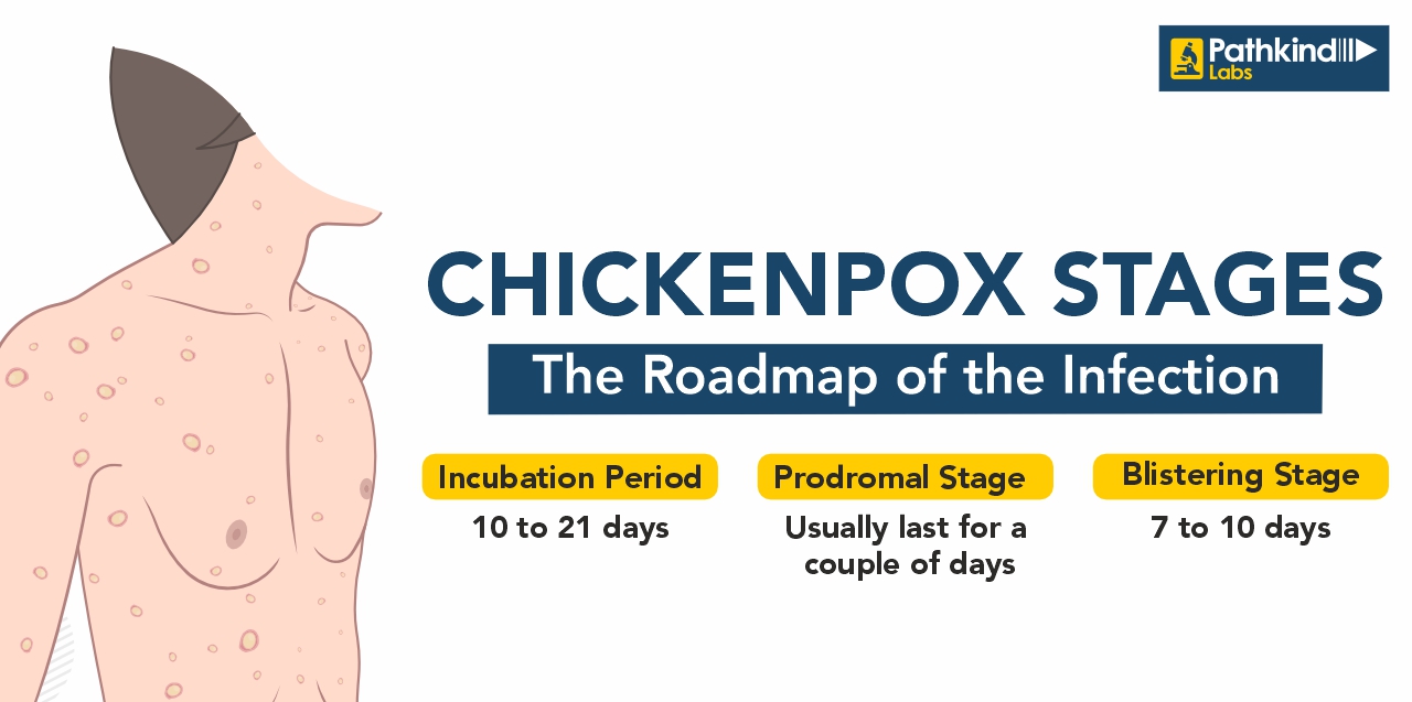 Mastering Chickenpox Symptoms Treatment Prevention